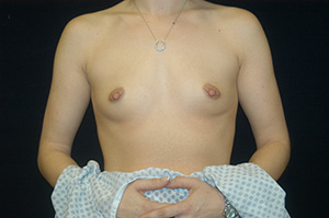 Breast Augmentation 11a